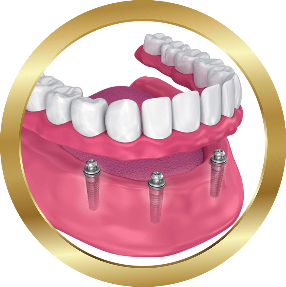 full mouth dental implants.