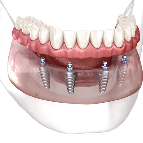 a full arch of dental implants with a denture prosthetic on top