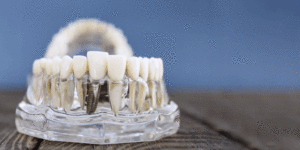 Dental Implant Model Showcasing Prosthetic Teeth on a Transparent Jaw for Educational.