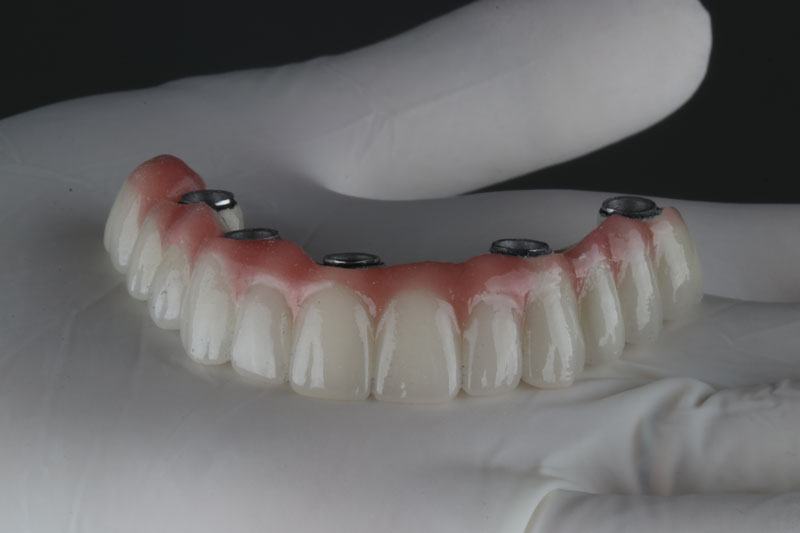 a full arch of teeth with dental implants holding it together