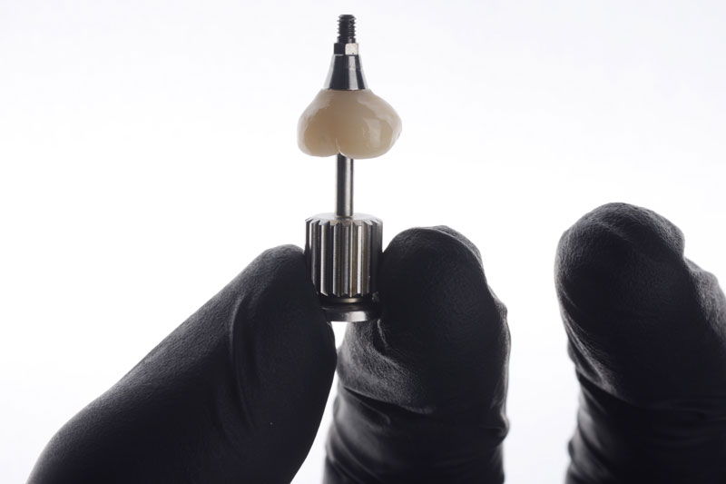 a single dental implant with a crown on top of it